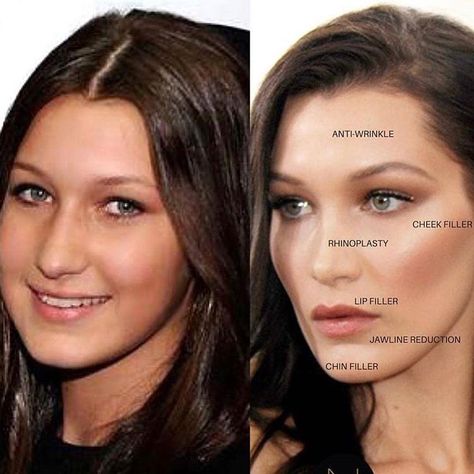 Love this transformation Bella Hadid! What do you think? Comment 👇 . . Beautiful Botox brow lift with filler in the cheek, lip, chin and… Plastic Surgery Transformation, Eyebrow Botox Lift, Bella Hadid Before And After Surgery, Bella Hadid Before Surgeries, Botox Face Lift, Bella Hadid Eyebrows, Bella Hadid Surgery, Brow Lift Botox Eyebrows, Bella Hadid Face