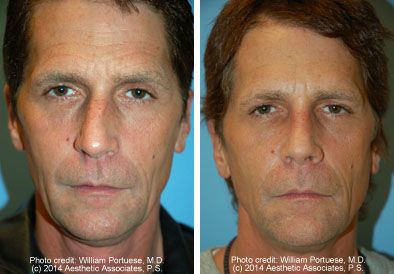 Nose Bone Exercise, Asymmetrical Nose, Crooked Nose, Forehead Lift, Rhinoplasty Surgery, Nose Surgery, Face Exercises, Makeup Class, Facial Plastic