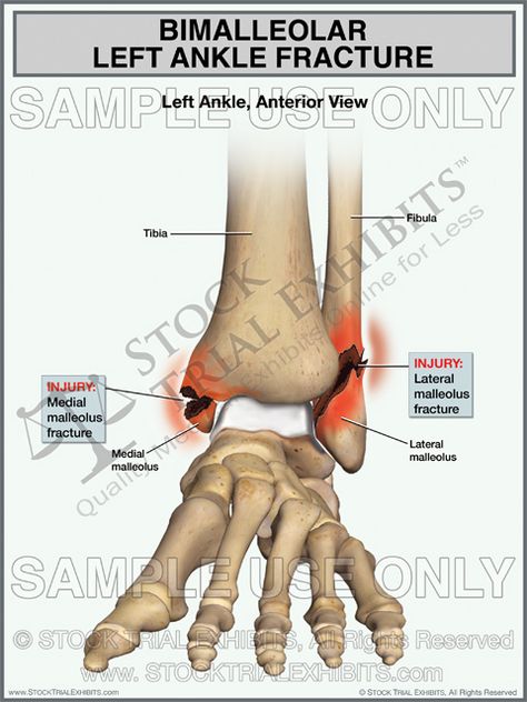 This trial exhibit depicts a bimalleolar left ankle fracture, showing fractures of both the medial malleolus and lateral malleolus, shown in the anterior view with descriptive labels of the anatomy and fracture injuries of the left ankle. Ankle Anatomy, Ankle Ligaments, Ankle Fracture, Presentation Format, Ankle Surgery, Chest Muscles, Medical Illustration, Anatomy And Physiology, Student Studying