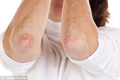 The impact a skin disorder such as psoriasis can have on mental health is too often underestimated by GPs and non-sufferers. Bed Sores, Skin Disorders, Skin Diseases, Natural Treatments, Leiden, Skin, Red