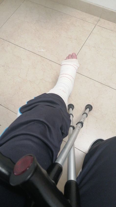 Leg Cast Aesthetic, Leg Fracture Snapchat Story, Injured Leg Fake Story, Broken Leg Snapchat Story, Fake Hospitalized Pictures, Leg Fracture Snapchat, Injured Leg Snapchat, Leg Bandage Snapchat, Broken Leg Cast