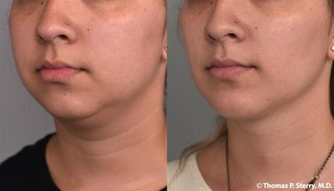 Photo Gallery - Buccal Fat Removal Case #225 Buckle Fat Removal, Buccal Fat Removal, Local Anesthesia, Double Chin Removal, Medical Website Design, Chin Implant, Facial Contouring, V Line, Hair Removal Cream