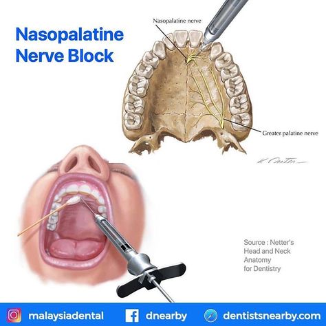 Not-so-Common Dental Blocks 👉 Akinosi Block⠀ 👉 Gow-Gates Injection Block 👉 Mental Nerve Block ��👉 Nasopalatine Nerve Block 👉 Posterior… Nerves Anatomy, Cranial Nerves Anatomy, Anatomy Dental, Dental Anesthesia, Dentist Career, Trigeminal Nerve, Dental Assistant Study, Dental Extraction, Dental World