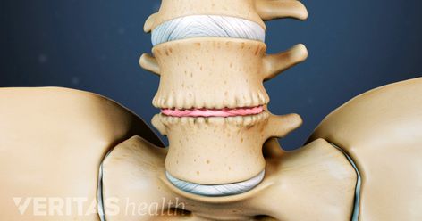 While most discs in the spine show signs of degeneration by age 60, back pain does not necessarily occur. Painful disc degeneration is generally manageable and tends to be resolved with time, but may be linked to other spinal conditions. Spinal Degeneration, Lumbar Disc, Intervertebral Disc, Spinal Fusion, Bulging Disc, Spinal Surgery, Sciatica Exercises, Strong Back, Spine Health