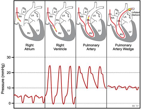 Pulmonary capillary wedge pressure Cath Lab Nursing, Cardiac Cath, Cath Lab Nurse, Heart Pressure, Heart Catheterization, Cardiac Anatomy, Cardiology Nursing, Nurse Anesthesia, Interventional Cardiology