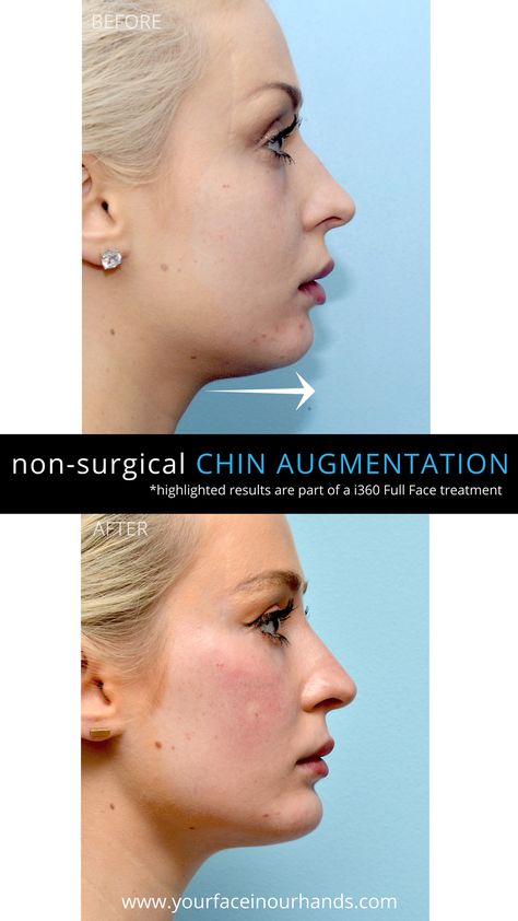 Double Chin Surgery, Nose Surgery Rhinoplasty, Acne Scar Diy, Chin Filler, Acne Scar Mask, Chin Augmentation, Chin Implant, Face Fillers, Hair Implants