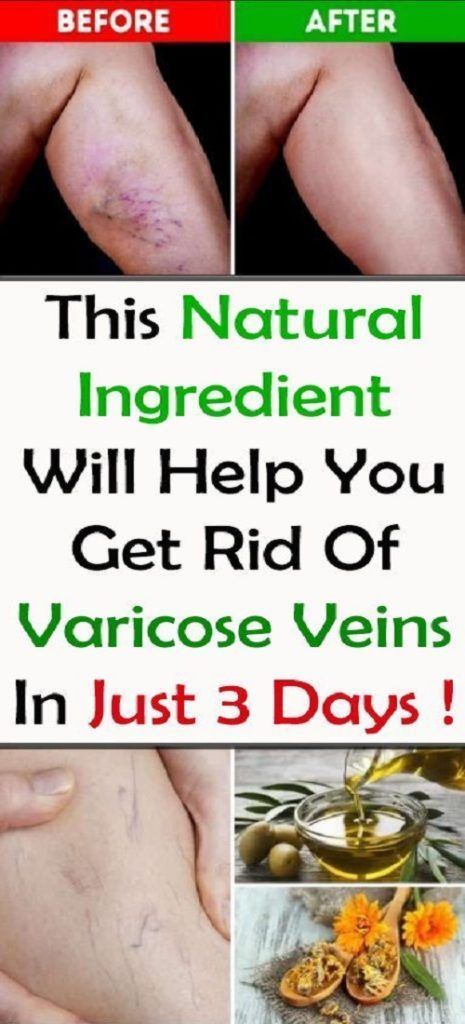 Varicose Vein Removal, Varicose Vein Remedy, Vein Removal, Cardiac Diet, Natural Moisturizer, Health Remedies, Herbal Remedies, Health Problems, Natural Health