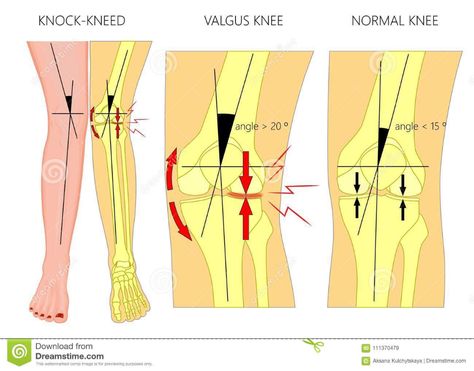 Shapes of the Legs.Normal and Curved Legs.Knock Knees.Bowed Leg Stock Vector - Illustration of arthritis, femur: 111370479 Leg Illustration, Knock Knees, Bow Legged, Shape Of You, Anatomy, Stock Vector, Vector Illustration, Yoga, Health