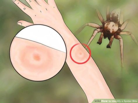 How to Identify a Spider Bite: 7 Steps (with Pictures) - wikiHow Spider Bites Pictures, Spider Identification, Different Spiders, Spider Bite, Spider Species, Spider Bites, Medical Information, Too Short