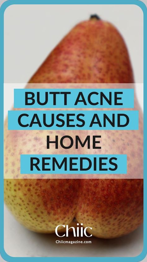 WHAT CAUSES PIMPLES ON BUTT How To Get Rid Of Buttocks Acne, Remedies For Back Acne, Buttocks Acne, Cetaphil Acne, Acne Prone Skin Care Routine, Pimples On Buttocks, Hacks For Girls, Painful Acne, Back Acne Remedies