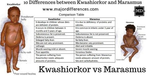 Difference Between Marasmus And Kwashiorkor In Table Form Kwashiorkor Vs Marasmus, Vascular Disorders Nursing, Muscle Of Mastication Diagram, Cushings Vs Addisons Disease Nursing, Quadrants Of The Abdomen, Communicable Diseases Notes, Nurse Teaching, Mitochondrial Dna, Medicine Notes