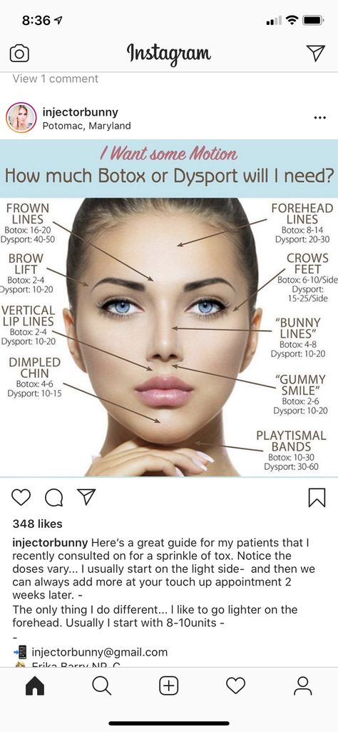 Botox Face Mapping, Dysport Injection Sites, Dysport Vs Botox Units, Botox Mapping, Botox Vs Dysport, Psych Np, Iv Nurse, Medical Esthetics, Face Injections