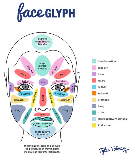 Understanding What Causes Rosacea Through Just Looking At Your Face Doterra Acne, Forehead Acne, Acne Scarring, Face Mapping, Natural Acne Remedies, Natural Acne, Home Remedies For Acne, Acne Causes, Acne Scar Removal