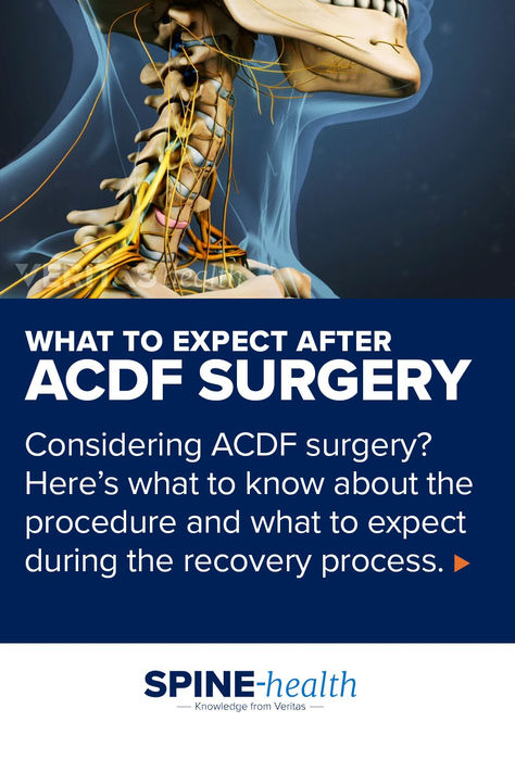 Considering ACDF surgery? Here's what to know about the procedure and what to expect during the recovery process. #ACDF #NeckSurgery Herniated Disk Surgery Recovery, Degenerative Disk In Neck, Acdf Surgery Recovery, Anterior Cervical Discectomy And Fusion, Acdf Surgery, Cervical Disc Degeneration, Cervical Spinal Canal Stenosis, Relieve Neck Pain, Spinal Fusion Surgery