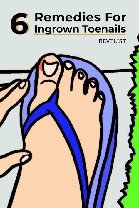 Foot Nail Problems Ingrown Toenail Remedies, Black Toenail Fungus, Toenail Pain, Infected Toenail, Nail Remedies, Homemade Facial Mask, Ingrown Toenail, Ingrown Nail, Ingrown Toe Nail