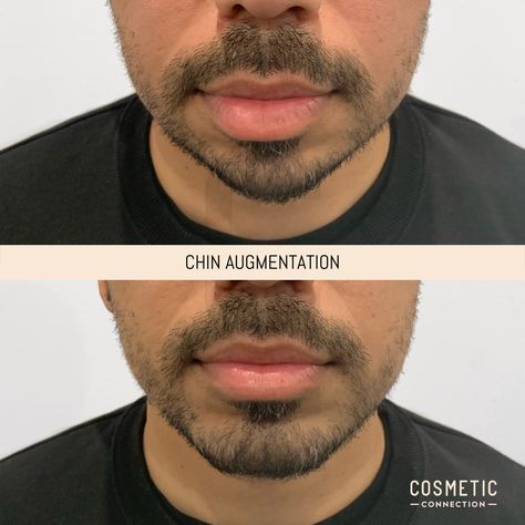 Chin Augmentation Purpose: Add shape and structure to the chin. How it works: Injections using dermal filler. Time it takes: 10-20 minutes Downtime: None Maintenance: Revisit 12-24 months on average Discomfort: Minimal, numbing options available Price: Please see website for our current pricing Suitability: 18+. Not suitable if you’re pregnant or breastfeeding Caution: Must be performed by an experienced, registered practitioner Recessed Chin, Chin Filler, Chin Augmentation, Facial Fillers, Chin Chin, Dermal Fillers, Lip Fillers, Body Mods, It Works