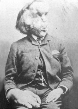 The last known picture of Joseph Merrick (circa 1890). Learn more about rare diseases at Discovery Fit and Health.   Image Credit: Royal London Hospital Archives Joseph Merrick, The Elephant Man, A Man, Elephant, Black And White, White, Black