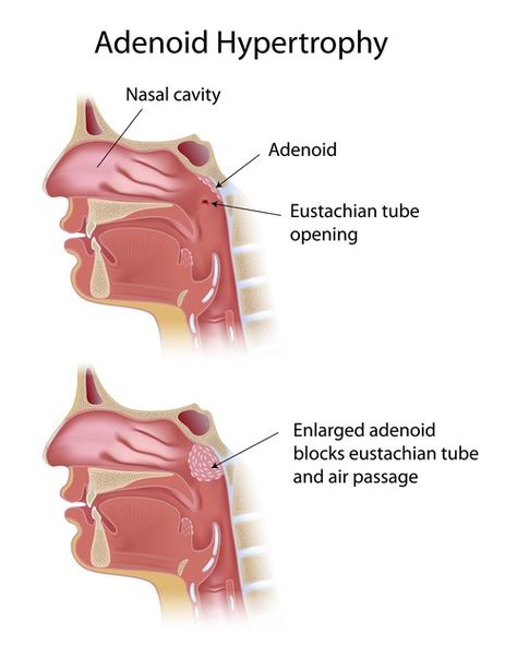 #Adenoids are lumps of tissue located above the #tonsils at the back of the #nose. Follow the #blog to know more about Adenoids and Adenoid Hypertrophy Acne On Nose, Tonsils And Adenoids, Nasal Cavity, How To Get Rid Of Pimples, Sinus Infection, When You Sleep, Research Institute, The Nose, Cotton Ball