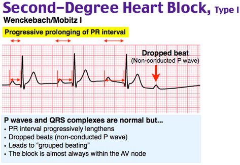 Second Degree Heart Block, Mobitz Type I (Wenckebach)  P waves and QRS complexes are normal but...  • PR interval progressively lengthens  • Dropped beats (non-conducted P wave)  • Leads to "grouped beating"  • The block almost always within the AV node   #Mobitz #Type1 #Type1 #SecondDegree #HeartBlock #Diagnosis #Cardiology #EKG #ECG #Electrocardiogram #Wenckebach Cardiology Notes, Respiratory Therapist Student, Ekg Technician, Cardiac Anatomy, Cardiology Nursing, Ekg Interpretation, Ecg Interpretation, Pr Interval, Medical Mnemonics