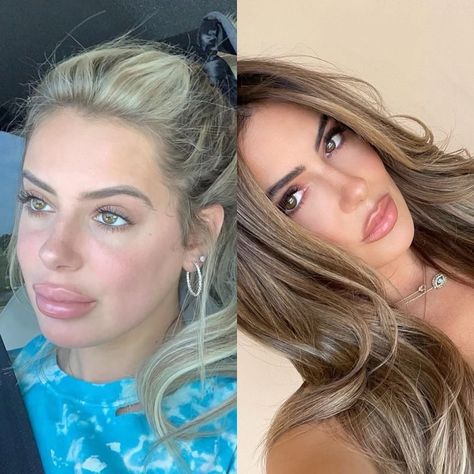 Brielle Biermann Warns Against Getting ‘Overfilled’ Lips Overfilled Lips, Brielle Biermann, Kroy Biermann, Kim Zolciak, Maria Shriver, Housewives Of Atlanta, Lip Injections, Reality Tv Stars, Lip Fillers