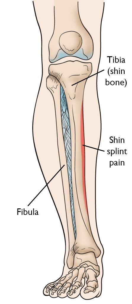 Shin splints refer to pain/tenderness along the front and inner side of the bone in the lower leg, the tibia. They are frequent for athletes and can cause significant pain. The medical term used to describe shin splints is “medial tibial stress syndrome” https://bit.ly/3kmicTN Lower Leg Muscles, Physical Therapy School, Calf Injury, Calf Leg, Leg Bones, Shin Splints, Fitness Program, Leg Pain, Medical Terms