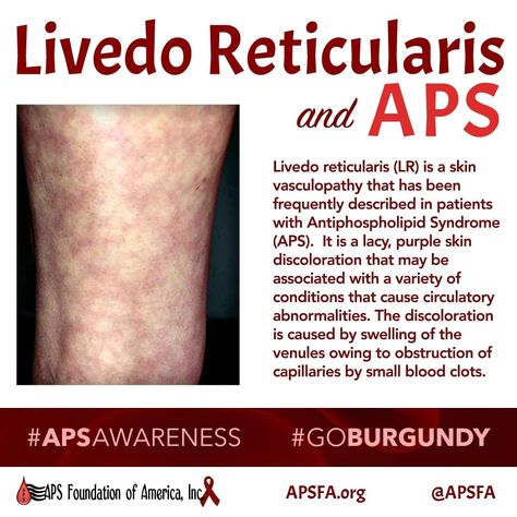 Livedo Reticularis, Autoimmune Disease Symptoms, Natural Teething Remedies, Sjogrens Syndrome, Auto Immune, Medical Laboratory Science, Disease Symptoms, Medical School Essentials, Ehlers Danlos