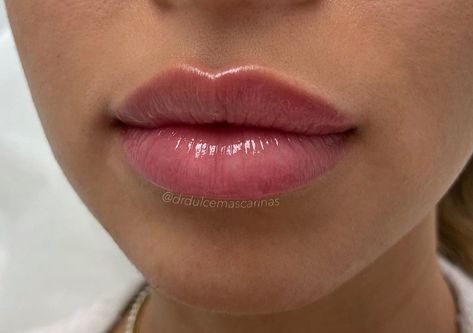 Bow Lips Shape, Lip Filler With Cupids Bow, Lip Filler On Full Lips, Lip Filler Cupids Bow, Defined Cupids Bow Lips, Pretty Lips Natural, Natural Looking Lip Fillers, Bow Shaped Lips, Versa Lip Filler