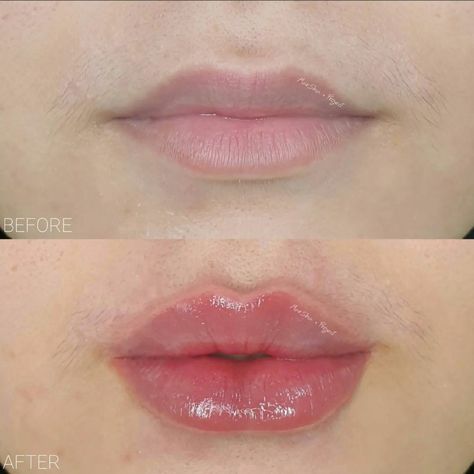 Lip Shapes For Fillers, Changing Lip Shape, Narrow Mouth Lip Filler, Light Lip Filler Before And After, Bottom Heavy Lip Filler, Heart Lip Filler, Lip Filler Bottom Lip Bigger, Lip Filler Inspiration Heart Shaped, Lip Filler Korea