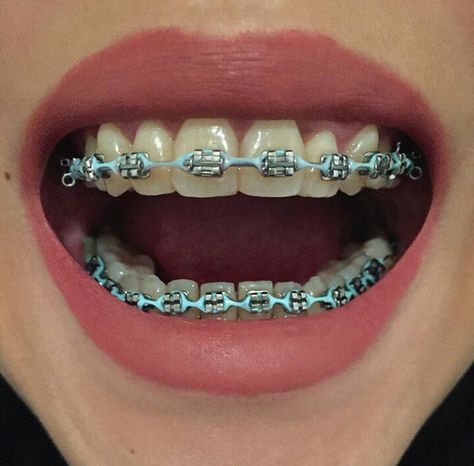 #braces #girlswithbraces #powerchain #headgeartubes Light Blue Braces, Power Chain Braces, Braces Colors Combinations, Braces Retainer, Kawat Gigi, Ear Tubes, Cute Braces Colors, Adult Braces, Braces Tips