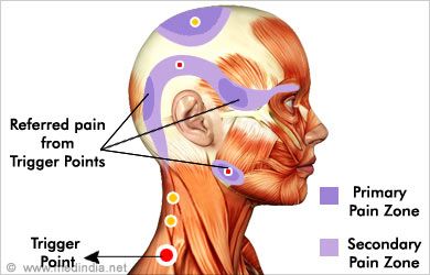 Punkty Spustowe, Myofascial Pain Syndrome, Psoas Release, Referred Pain, Trigger Point Therapy, Head Pain, Back Pain Remedies, Myofascial Release, Health Ideas