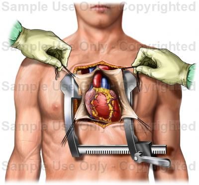 Open Heart Surgery Heart Facts, Lady Lawyer, Human Heart Anatomy, Heart Warrior, Medical School Life, The Surgeon, Perfect Heart, Open Heart Surgery, Congenital Heart Defect