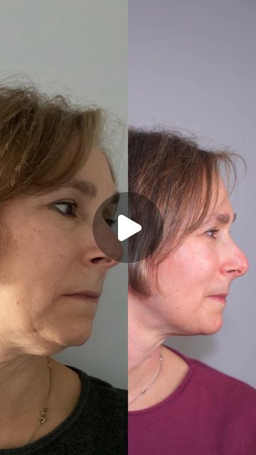 915K views · 38K likes | Valeriia Veksler Face Fitness Nurse on Instagram: "FIRM JAWLINE in 7 days😱

What do you think of her results? Instead of getting fillers or plastic surgery, let’s learn about facial muscle anatomy. Issues like jowls, marionette lines, double-chin, and neck skin sagging, are caused by tensed muscles that impair lymph outflow from the face. Muscles get shortened, lymph gets trapped, and skin loses support from underneath and saggs. To relax muscles, drain excess lymph, we need to do face fitness. I’ll teach you how to do it correctly in my upcoming webinar. 

Comment below what you think of her results! 

#snatchedjawline #definedjawline #jowls #facefitness #facemassage 

Disclaimer: not a medical advice. For education purpose only. Consult with your physician if yo Facial Muscles Anatomy, Face Muscles, Facial Exercise, Face Fitness, Marionette Lines, Relax Muscles, Muscle Anatomy, Face Exercises, Facial Exercises