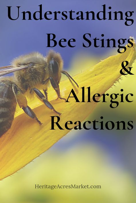 Beekeeping comes with one little setback- the stings! Sure, we do our best to avoid getting stung. And, yes, getting stung hurts! But there is a bigger reason to avoid stings, one that could potentially be fatal.  #bee #bees #beekeeping #beekeeper #allergy #allergic #reaction #venom #sting #stinger #anaphylaxis Wasp Sting Remedy Swelling, Bee Sting Remedy, Bee Sting Swelling, Dog Bee Sting, Wasp Sting Remedy, Hornet Sting, Remedies For Bee Stings, Sting Relief, Wasp Stings