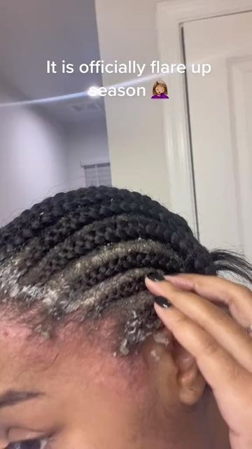 salonready_com on Instagram: "*Transparent post* I hateeee dealing with seborrheic dermatitis times like these I just wanna shave my head bald! I’ve had these braids in 2 weeks today . No matter the style this time of year my entire body is under attack ! ❤️ Follow me to get more inspiration and start your pretty look with us @salonready_com . . . #bohobraids #twobraids #feedinbraids #feedinstyles #naturalhair #naturalhairspo #natural #cutestyles #blackgirl #blackhairstyle #braid #twisttutorial Braids For Very Short Hair, Gray Haircuts, How To Be Pretty, Short Grey Haircuts, Pretty Hair Cuts, Scalp Braids, Curly Hair Beauty, Shave My Head, Hair Inspiration Short