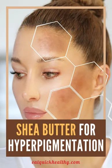 Shea Butter Hair Moisturizer, Shea Butter For Skin, Diy Shea Butter, Get Rid Of Hyperpigmentation, Shea Butter Recipes, Shea Butter Benefits, Shea Butter Hair, Skin Hyperpigmentation, Beauty Tips For Glowing Skin