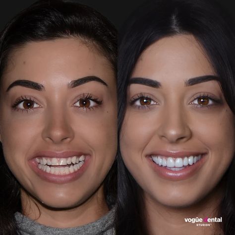 Our results gallery shows before and after images for treatments such as porcelain veneers, Invisalign Lite, Invisalign Full, teeth whitening, and gum laser surgery, Invisalign Before And After, Laser Surgery, Porcelain Veneers, D Images, General Dentistry, Teeth Whitening, Surgery, Gum, Porcelain