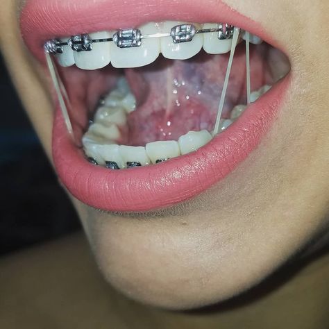 Braces Girl, Braces Journey, Types Of Braces, Braces Elastics, Braces Tips, Herbal Toothpaste, Remedies For Tooth Ache, Braces Girls, Orthodontic Appliances