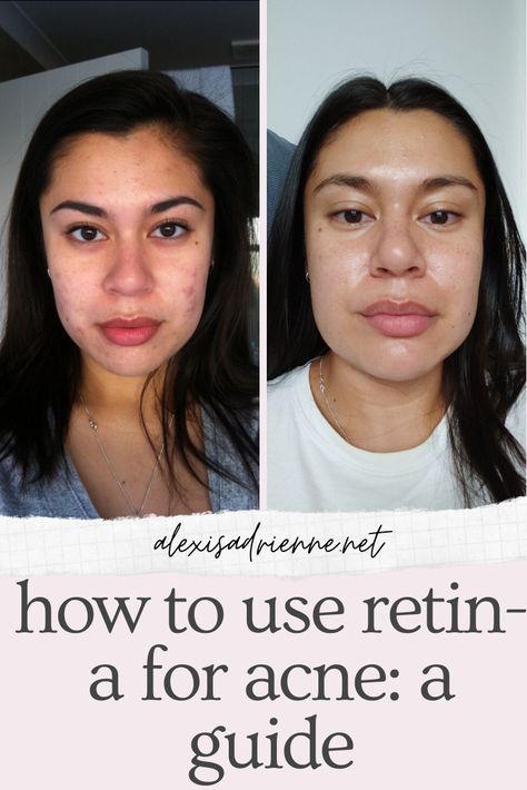 this is a guide for how to use retin-a for acne and wrinkles. it doesn't matter if it's retin-a cream or gel that you have, any tretinoin product works the same for acne and wrinkles. Retin A Cream, Tretinoin Progress, Retin A Routine, Retinoids Before And After, A313 Cream, How To Use Tretinoin Cream, Tretinoin Before And After Acne, Retin A Before And After, Tretinoin Acne