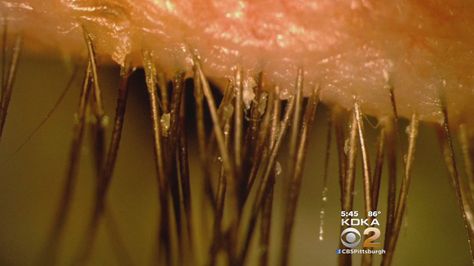 Eye Mites, Spread From Pets To Owners, Can Cause Serious Damage « CBS Pittsburgh Eye Mites, Pittsburgh, Conditioner, Canning