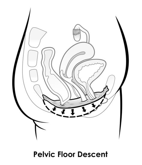 Prolapse and Running Physio Guide to Avoid Prolapse Worsening Post Prolapse Surgery, Prolapse Exercises, Pelvic Exercises, Pelvic Floor Exercise, Floor Exercise, Start Exercising, Deep Squat, Activities Of Daily Living, Exercise Videos