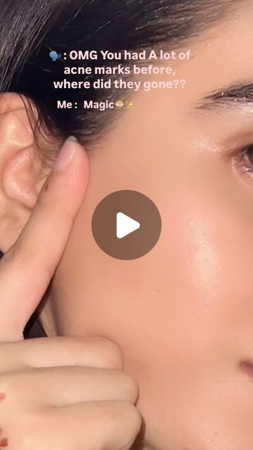 Zarnab🤍 | Yes its true , Acne marks ko ap hamesha k leay by by kr skty and can get glass skin , srf remedies use kr k😍♥️✨  I started series of daily... | Instagram Remedies For Acne Marks, Homemade Remedy For Acne, Remedy For Acne Marks, Acne Marks Remedies, Daily Skin Care Routine Steps, Acne Pictures, Acne Prone Skin Care Routine, Get Glass Skin, Boiled Rice