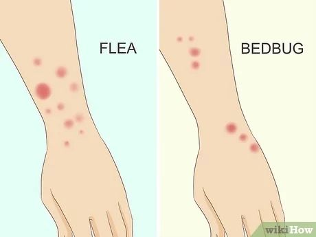 Different Bug Bites, Bed Bug Bites Pictures, Types Of Bug Bites, Signs Of Bed Bugs, Bug Bite Relief, Ant Bites, Rid Of Bed Bugs, Hydrocortisone Cream, Bed Bug Bites