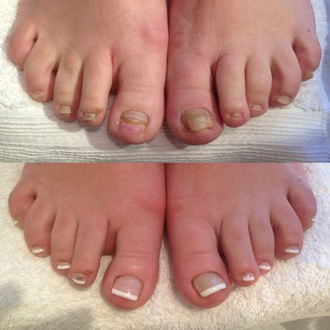 Before and after summer gel toes :) Summer Gel Toes, Pedicure Pictures, Nail Falling Off, Toes Nails, Fake Toenails, Gel Pedicure, Infinity Nails, Acrylic Nails At Home, Gel Toe Nails