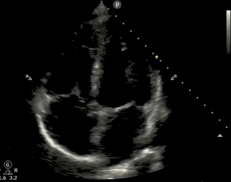 Cardiac Ultrasound (Echocardiography) Made Easy: Step-By-Step Guide - POCUS 101 Echocardiography Aesthetic, Cardiac Sonography Aesthetic, Shock Types, Echo Ultrasound, Sonography Aesthetic, Echocardiography Ultrasound, Cylinder Formula, Cardiac Ultrasound, Central Venous Pressure