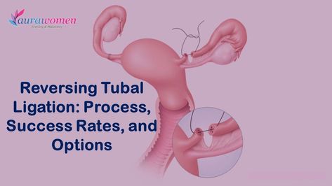 #aurawomen #aurasuccess #sterilization #tubalreversal #tuballigation  #increase #egg #quality #women #follicle #infertility #infertilityawareness #fertility #fertilityjourney #fertilityawareness #ivf #ivfjourney #ivfsuccess #ivfhospital #infertilityadvisor Tubal Reversal Surgery, Female Sterilization, Tubal Reversal, Gender Selection, Ivf Success Rates, Fertility Health, Ectopic Pregnancy, Ivf Success, Ivf Clinic