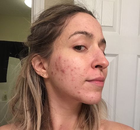 The Secret that Cleared My Severe, Hormonal, Cystic, Itchy, Adult Acne after 17 Years – Part 2 – Brooke's Beauty Bazaar Cystic Hormonal Acne, Hormonal Acne Routine, Hormonal Acne Recipes, Cystic Acne Routine, Acne Diet Plan Hormonal, Hormonal Acne Tips, Cheek Acne Cause, Acne On Cheeks, Hormonal Acne Skincare Routine