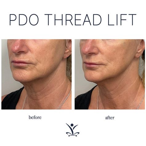 Thread Lift Face Before And After, Pdo Thread Lift Before And After, Thread Lift Face, Pdo Thread Lift, Pdo Threads, Thread Lift, Skin Care Face Mask, Botox Fillers, Cool Sculpting