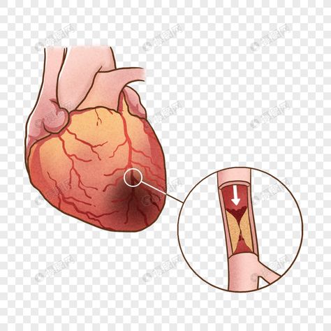 Myocardial Infarct, Health Graphics, Internal Medicine, Cardiology, Best Resolution, Free Picture, Body Health, Clipart Images, Free Pictures