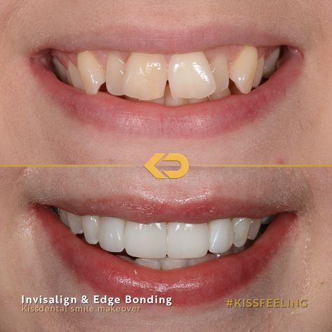 How incredible is this composite veneer makeover?! This patient was looking for a brighter more symmetrical aligned smile. The Dr created a plan of invisalign and whitening and finished off with composite edge bonding. Book in for a FREE consultation at any of our clinics: 📍Manchester City centre 📍Flixton 📍Altrincham 📍Knutsford 📍Alderley Edge 📍Liverpool 📍Bramhall Head to kissdental.co.uk to get booked in Composite Bonding, Composite Veneers, Alderley Edge, Manchester City Centre, Front Teeth, Got Books, City Centre, Free Consultation, Manchester City