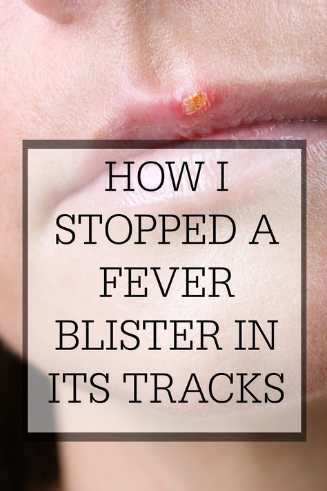 Essential Oils For Fever, Fever Blister Remedy, Blister Remedies, Blister On Lip, Home Remedies For Fever, Natural Remedies For Fever, Fever Blister, Essential Oils For Colds, Home Remedy For Cough